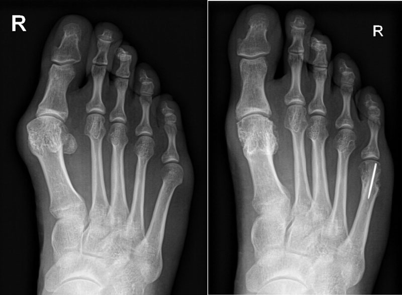 Hallux Valgus Bild